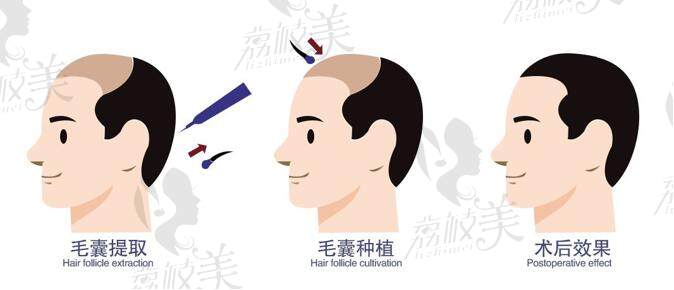 植发的操作流程演示