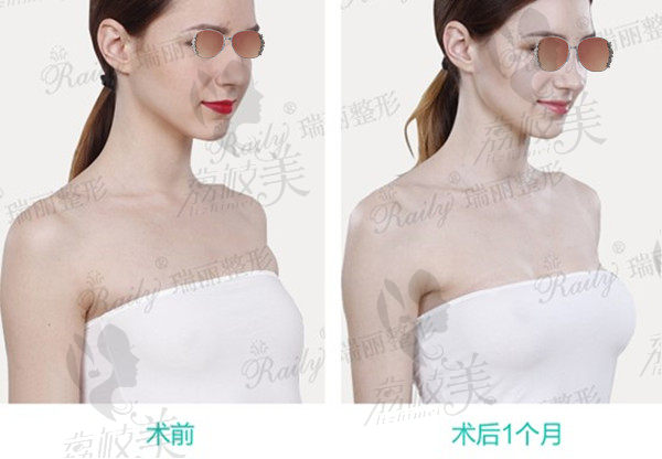 术后一个月穿抹胸裙变化