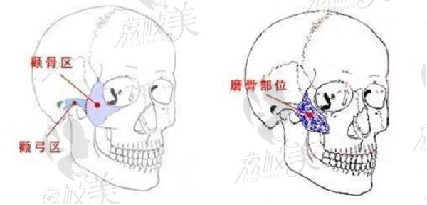 西安国医卫国强颧骨颧弓截骨