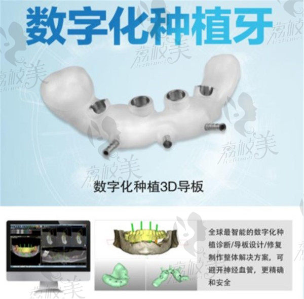 3D数字化导航种植牙优势