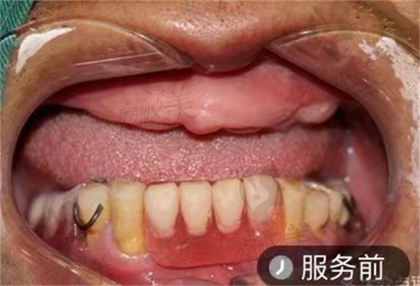 重庆韩佳牙博士术前照片