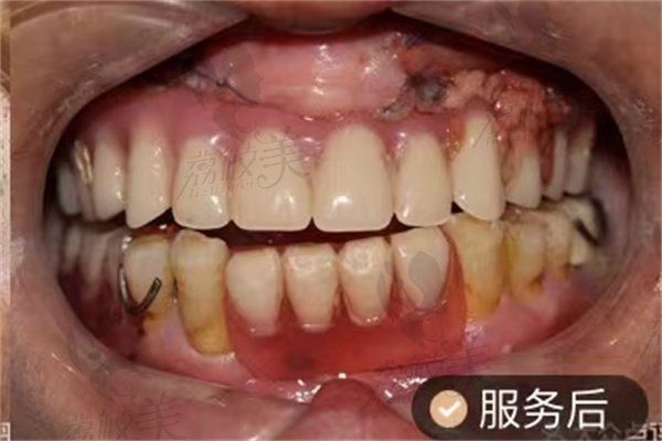 重庆韩佳牙博士术后种植牙修复照片