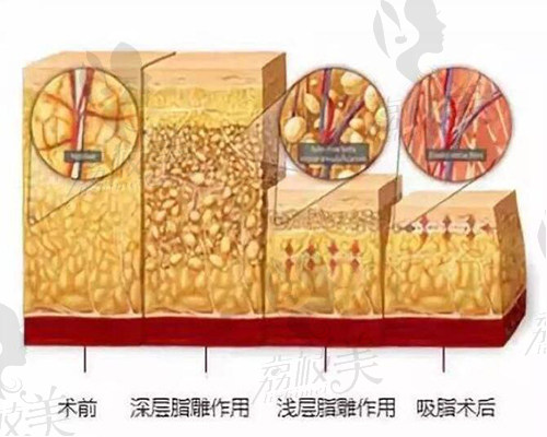 吸脂形象圖