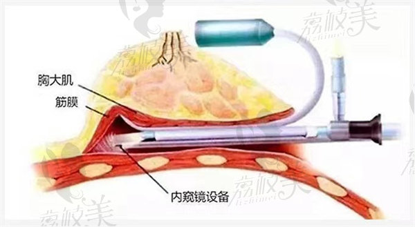 內(nèi)窺鏡隆胸技術(shù)