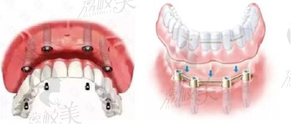 大川齿科all-on4种植牙技术