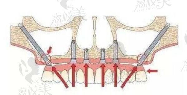 大川齿科穿颧穿翼种植牙技术
