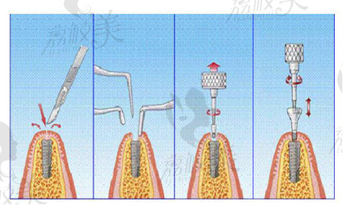种植牙流程示意图