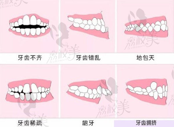 上海時代天使隱形矯正適用人群