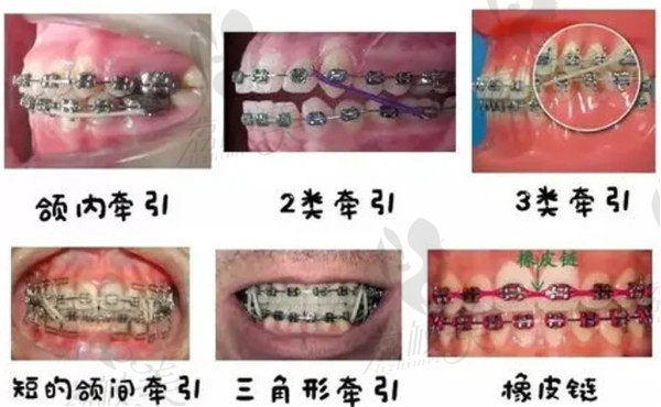 牙齿矫正挂行皮筋的用途