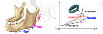 北京圣嘉新下颌成角截骨术