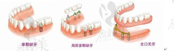 上海松丰齿科种植牙优势