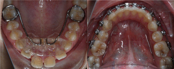 4月8日复诊牙齿变化情况