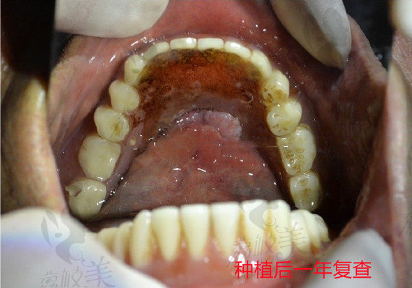 上海松丰全口种植牙后