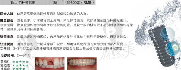 瑞士ITI种植牙优势