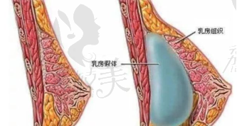 北京麗都雙平面隆胸