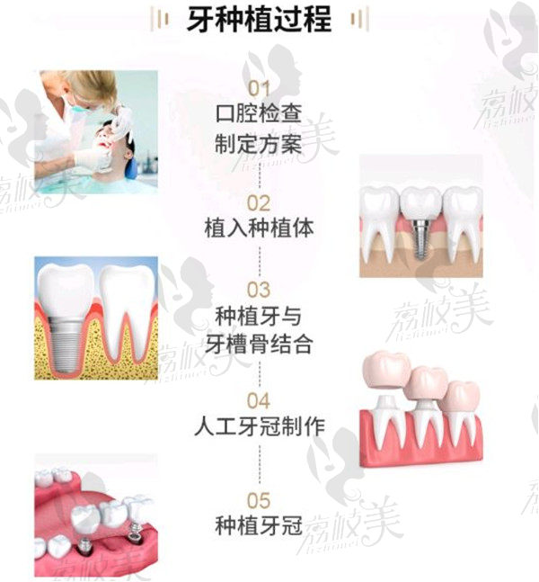 上海仁爱口腔医院种植牙流程