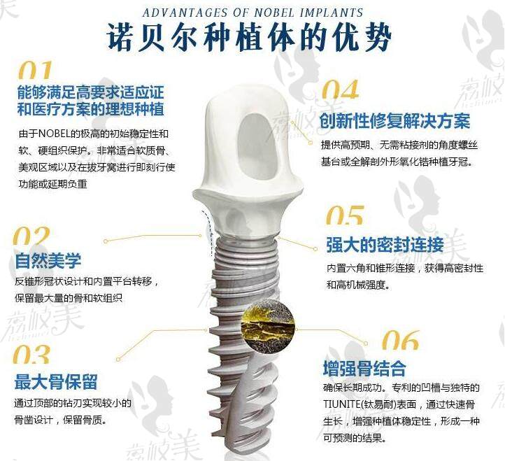 瑞典諾貝爾種植牙體系優(yōu)勢