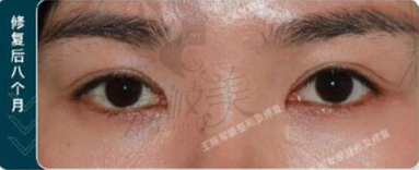 王振军修复肉条双眼皮8个月的情况