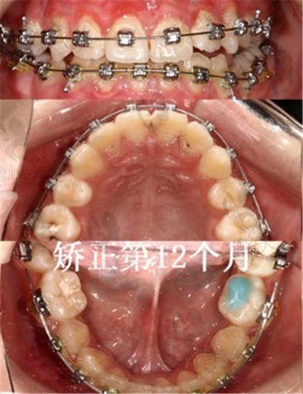 术后12个月的我