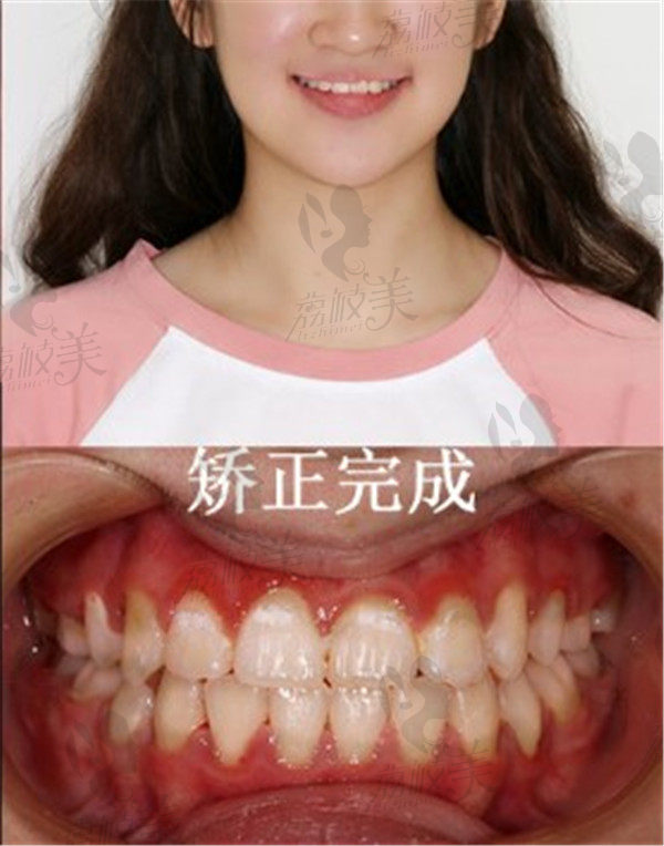 矫正完成的我
