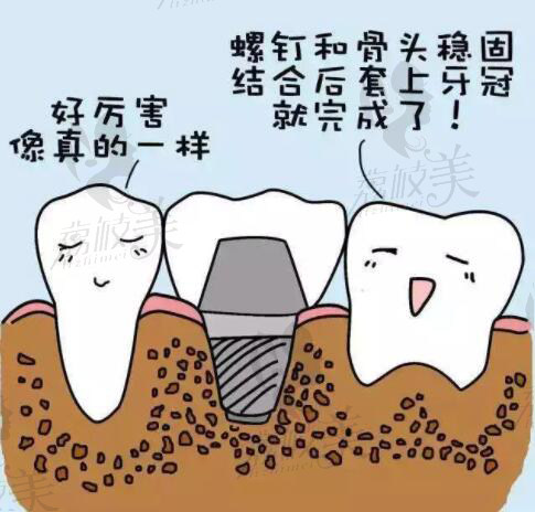 种植牙
