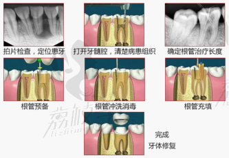 北京鈦植口腔顯微鏡根管治療