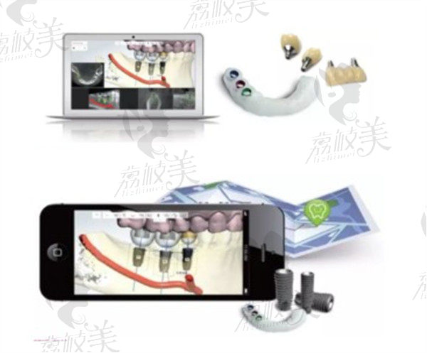 上海雅悦齿科数字化种植牙