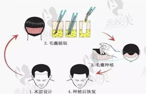 植发原理过程