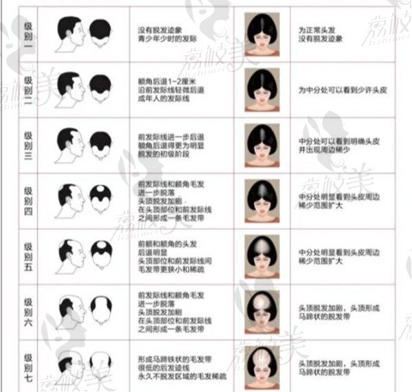 脱发等级划分