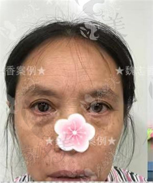 魏志香院长：眼袋修复+面部提升术前术后