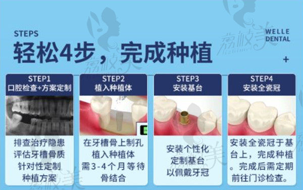 上海维乐种植牙流程