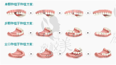 牙齿种植