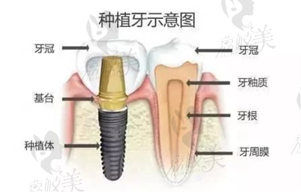 种植牙的示意图