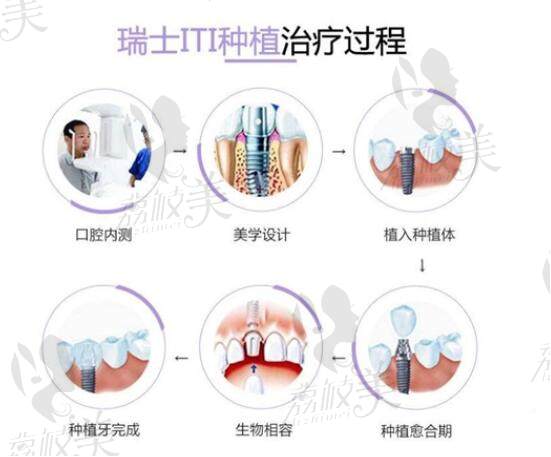 瑞士ITI种植牙治疗过程