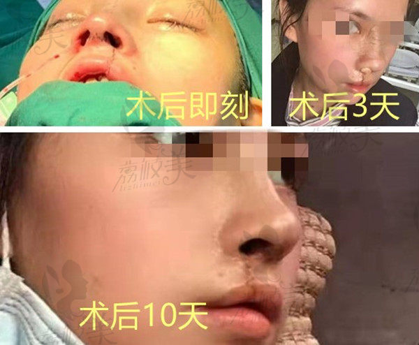 重庆美仑美奂毋巨龙唇腭裂修复术后恢复国产