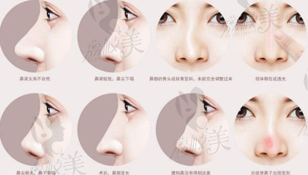 上海哪里做鼻子修复比较厉害？这份高难度鼻修复医生名单建议收藏！