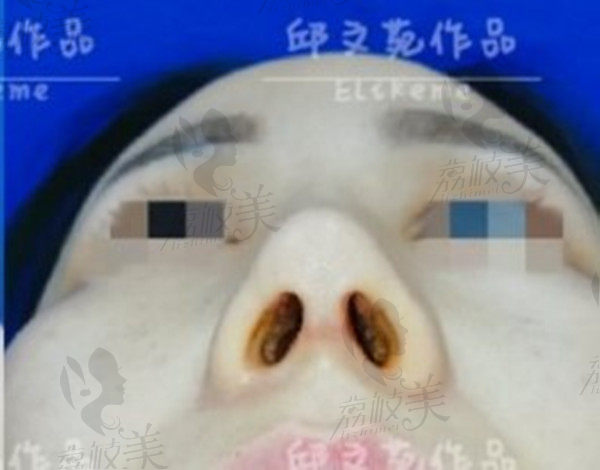 上海伊莱美邱文苑修复后的鼻子