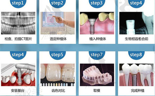 珠海六和口腔门诊部种植牙过程