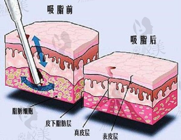 吸脂手术模拟对比图