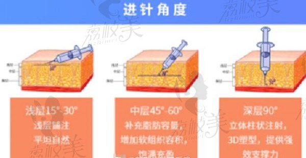 西安国医王爱武吸脂进针角度