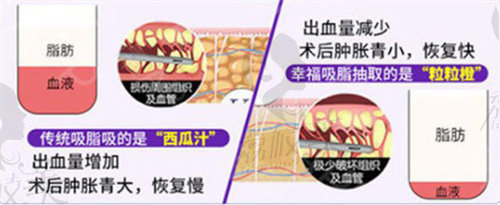 福州美贝尔快乐吸脂术