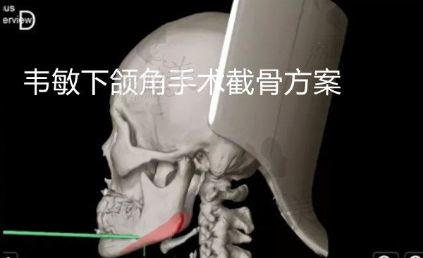 上海九院韦敏医生的下颌角截骨方案