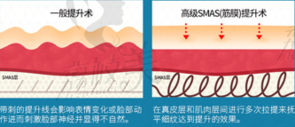 深部复合小切口拉皮VS一般提升术