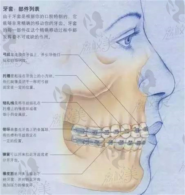 口腔内的固定矫治器