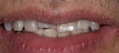 上海鼎植口腔半口种植牙的外观