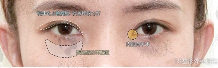 多层双眼皮手术方案