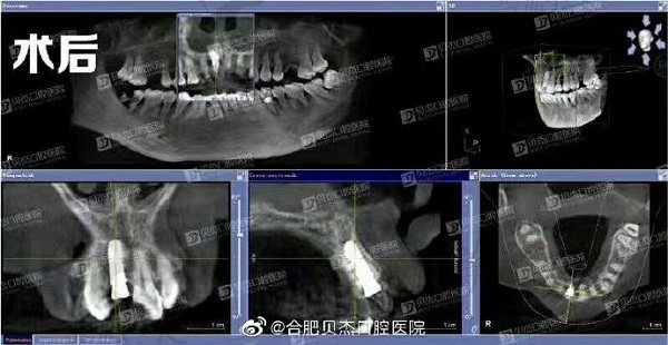 合肥贝杰口腔医院种植牙