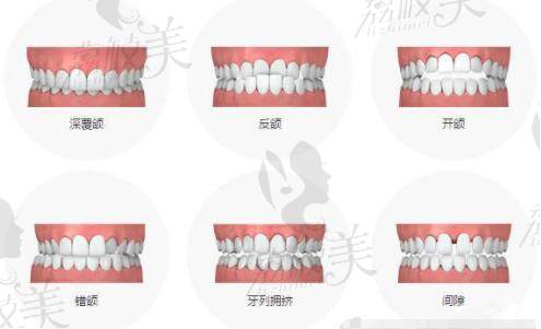 需要做牙齿矫正的牙齿