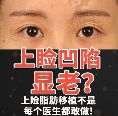眼皮松弛眼窝凹陷怎么办？韩国TS上睑脂肪重配置能解决吗？
