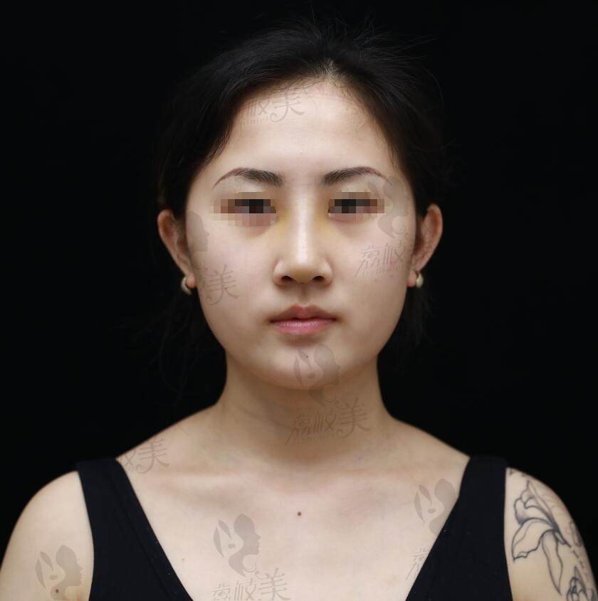 北京新星靓宫风勇假体隆鼻术后